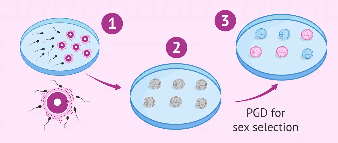 Can You Choose Gender With IVF? A Simple Guide to IVF Gender Selection